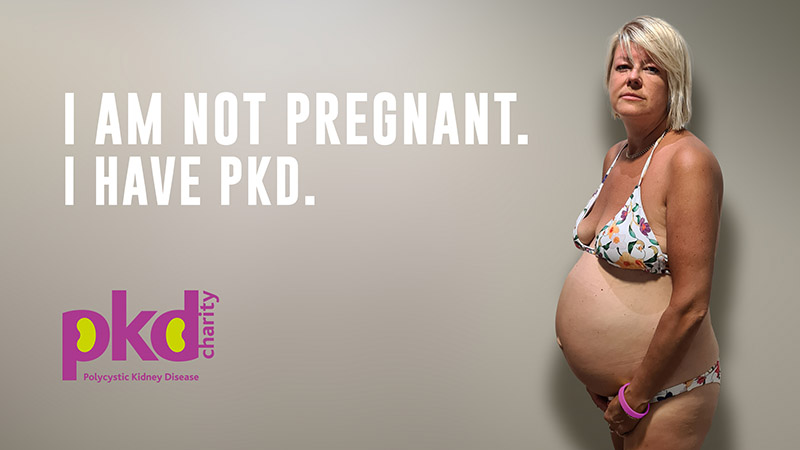 Living With a PKD Belly