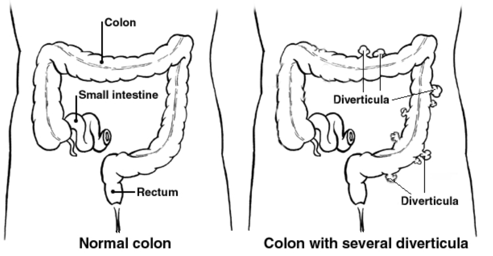 Picture showing a normal colon versus a colon with diverticula. The normal colon is a long worm-like tube running from the small intestine to the anus in a question mark shape. The sides are largely smooth. In comparison, the colon with diverticula has some bulges or pouches coming from it. These are small dead ends.