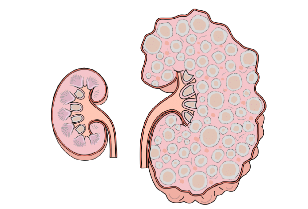 A picture of a normal kidney compared with an ADPKD kidney. The ADPKD kidney is much larger and has many cysts of varying size.