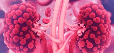Illustration of polycystic kidneys in bright pink.