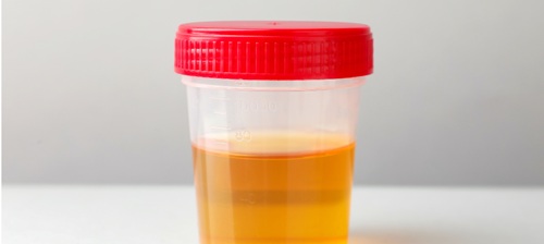 Specimen pot with urine 