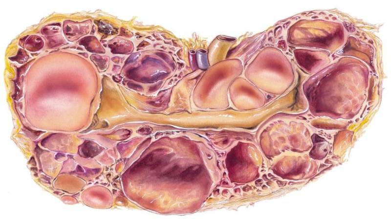 New study aims to prevent cyst formation in ADPKD
