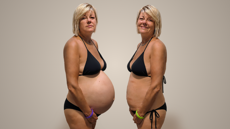 Katie’s PKD belly: ‘I can’t believe I carried all that weight’