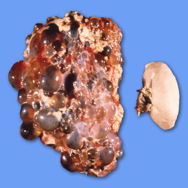 PKD Kidney V normal kidney
