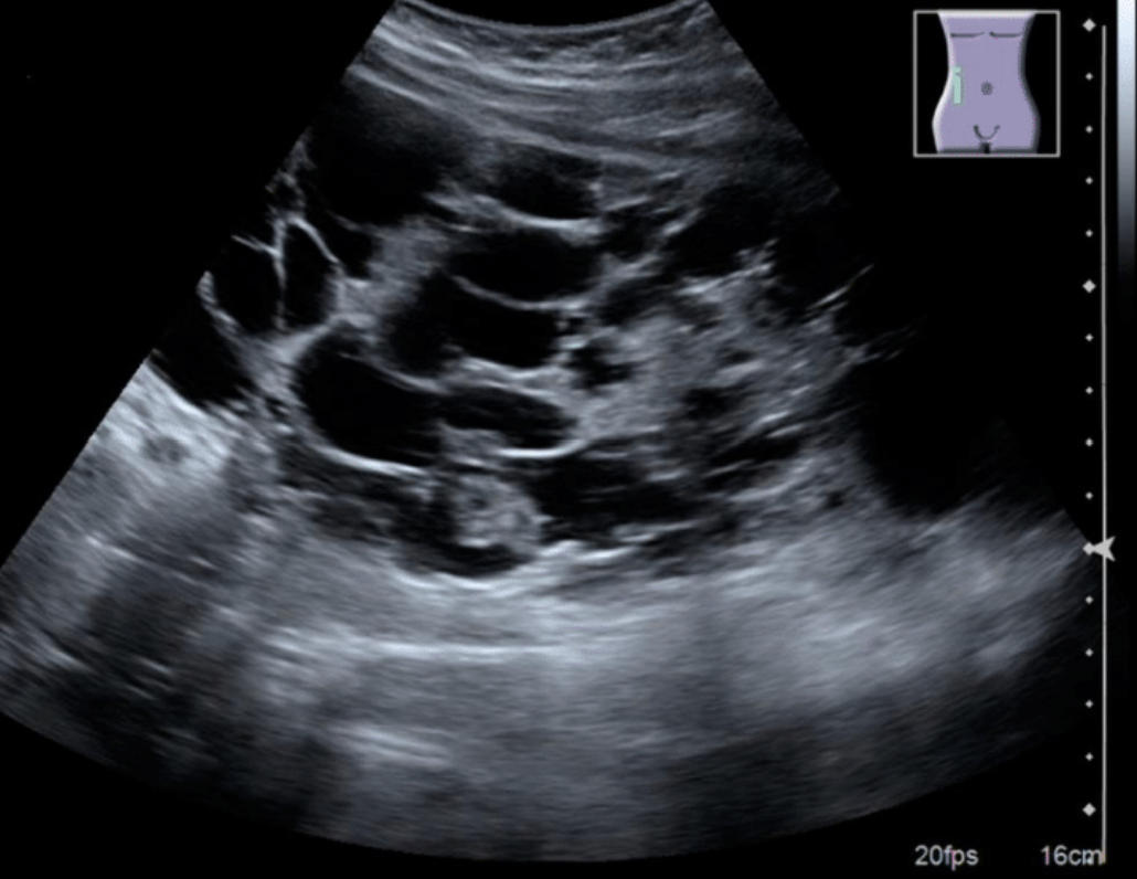 An ultrasound image of a PKD kidney. The cysts appear as circles in a different colour.