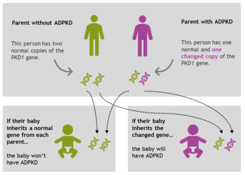 Diagram showing how ADPKD is inherited, as explained in the text.
