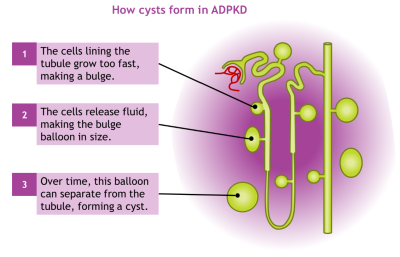  A picture showing cysts forming in a kidney nephron. Bulges are shown from the tubule. Some of these have ballooned in size and separated from the tubule, becoming cysts.