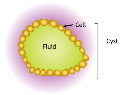 A picture of a kidney cyst. A circle of cells is shown, with fluid held in the middle.