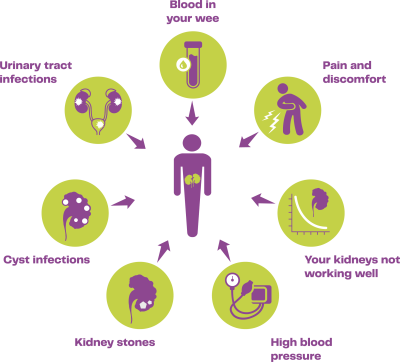 Diagram showing the more common symptoms of ADPKD: high blood pressure, urinary tract infections, cyst infections, blood in your wee, kidney stones, pain and discomfort, and your kidneys not working well.