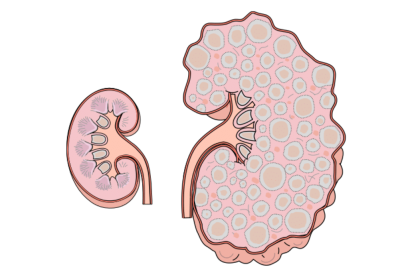 A picture of a normal kidney compared with an ADPKD kidney. The ADPKD kidney is much larger and has many cysts of varying size.