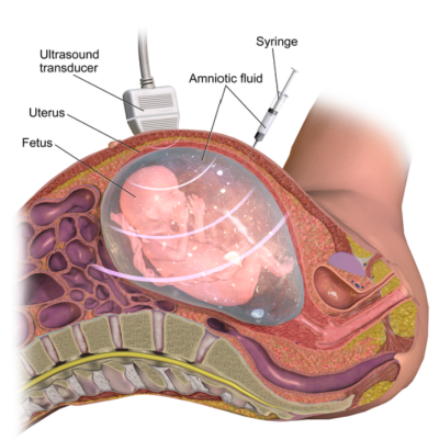 An illustration showing the process of amniocentesis, as described in the picture legend.