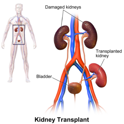 A diagram showing where the transplanted kidney is placed. The transplanted kidney sits lower than the patient’s own kidneys, in the groin. The blood supply and bladder are connected as we explain above.